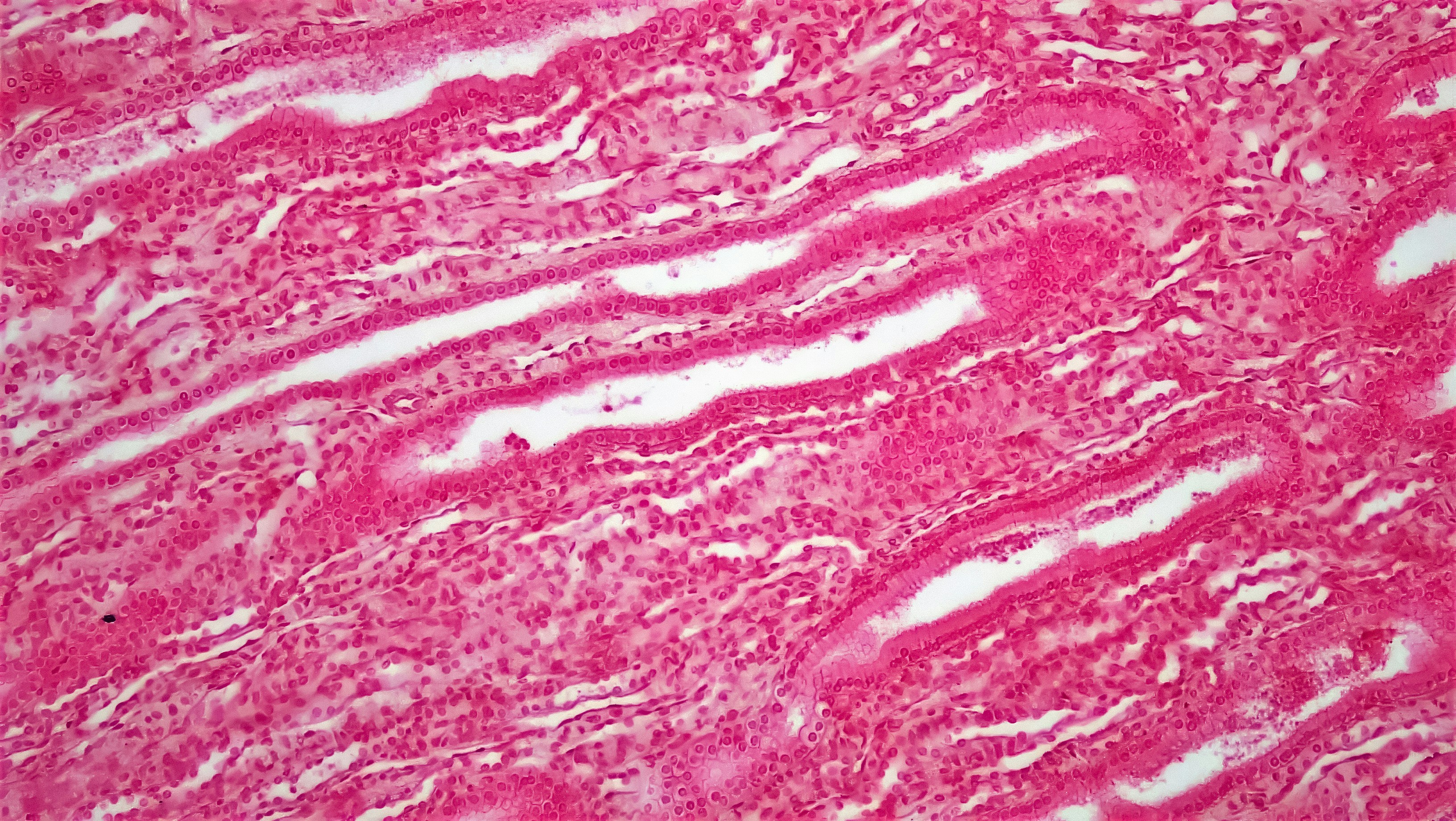 TRACED: Imagen in vivo de la difusividad intrínseca extracelular, la tortuosidad, la distribución del tamaño celular y la densidad celular en pacientes con glioma humano