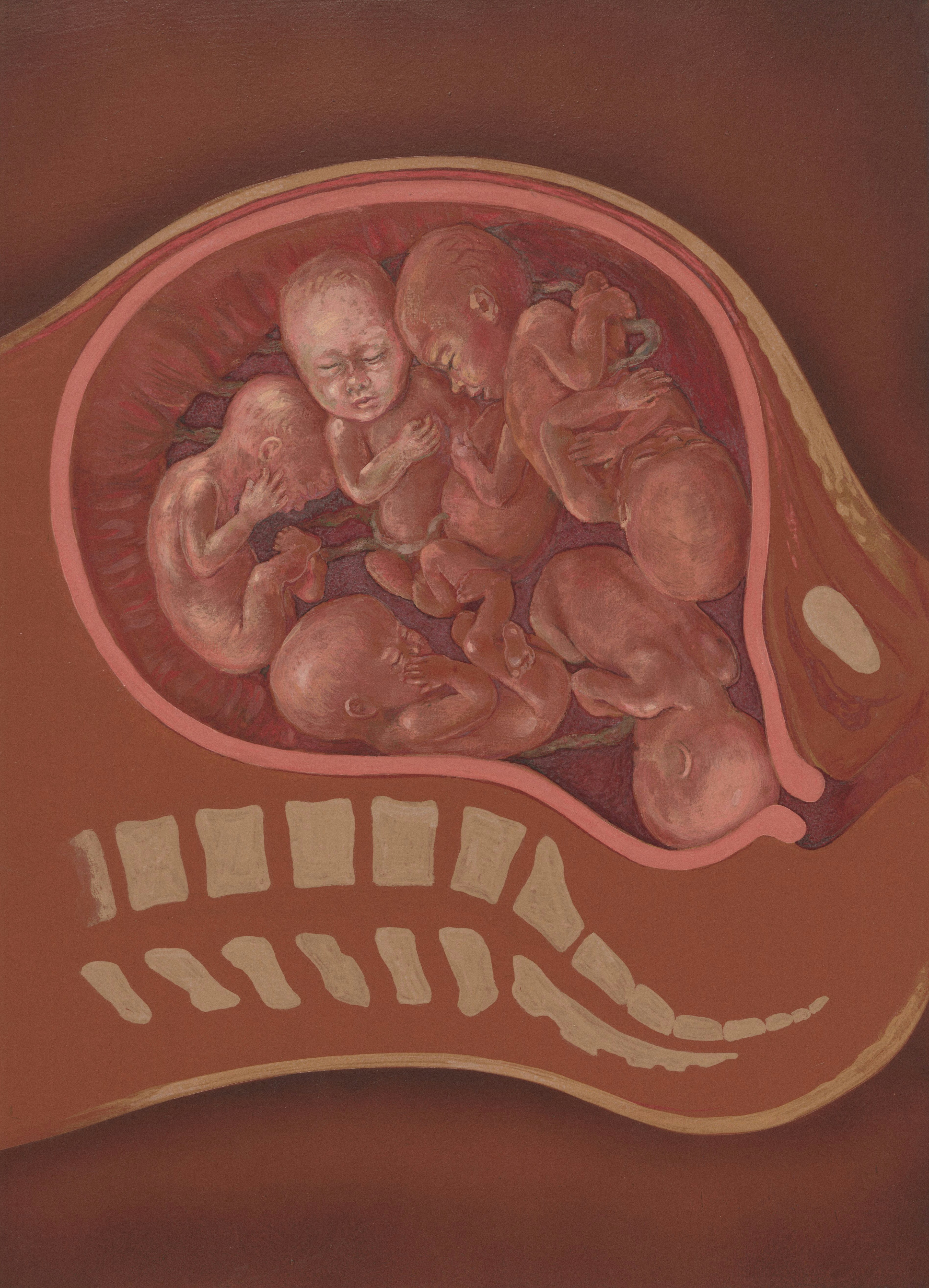 Aprendizaje de Representación Jerárquica Multivista de la Hemodinámica Fetal para la Detección de Hipertensión Materna en el Borde