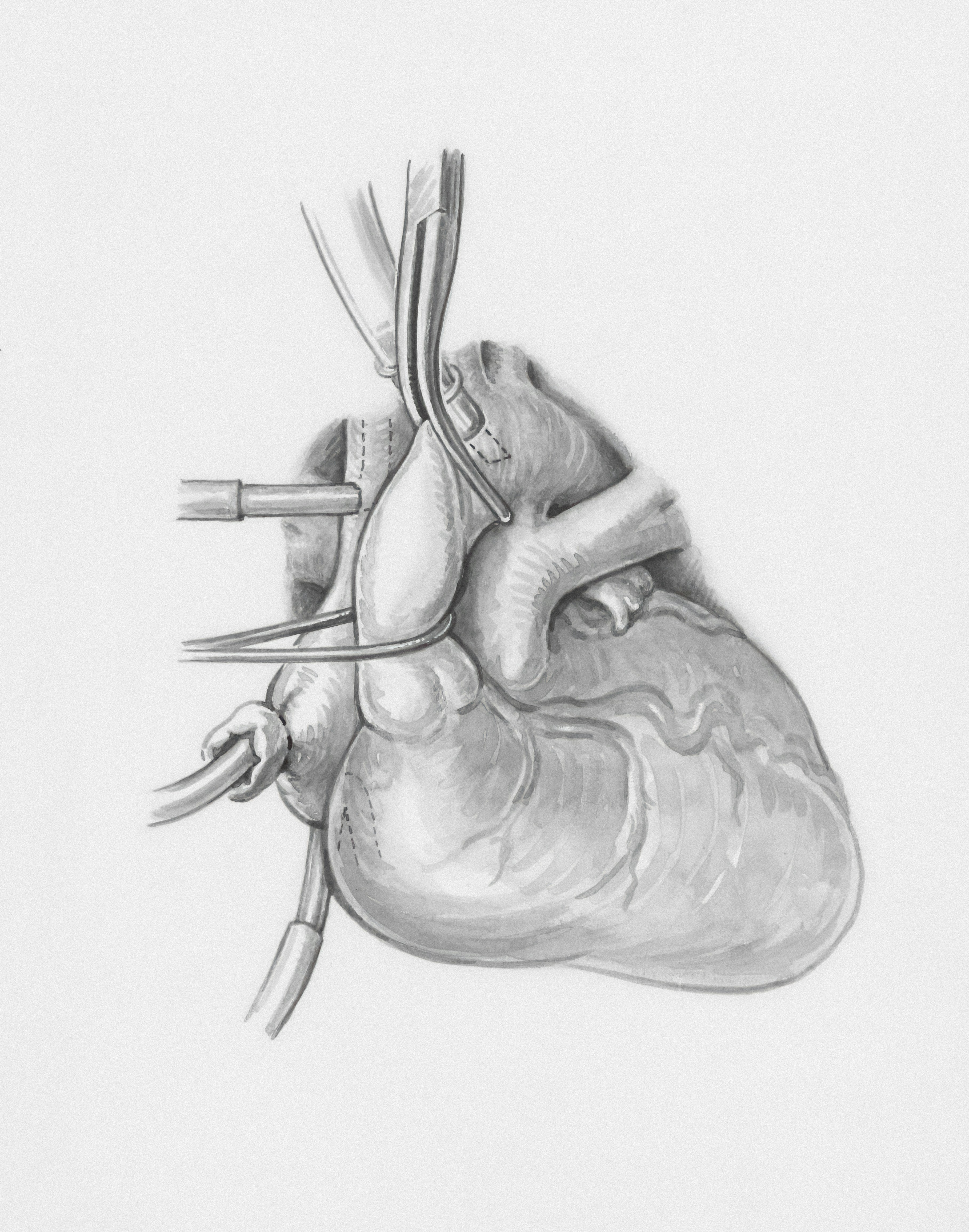 Diagnóstico robusto y explicable de la válvula aórtica bicúspide mediante ensembles apilados en ecocardiografía
