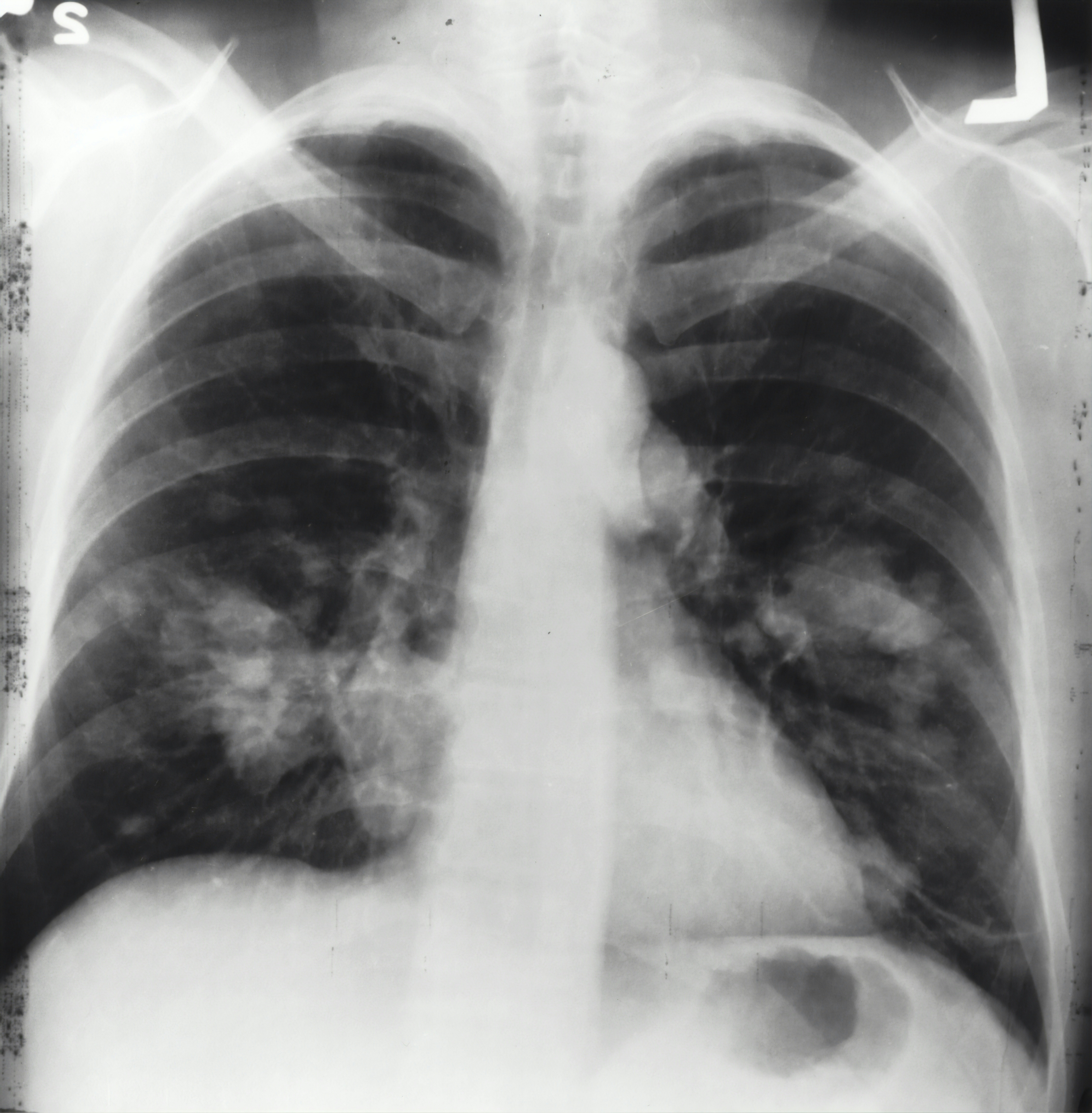 Estado de adquisición oculta fallos en IA de nódulos pulmonares