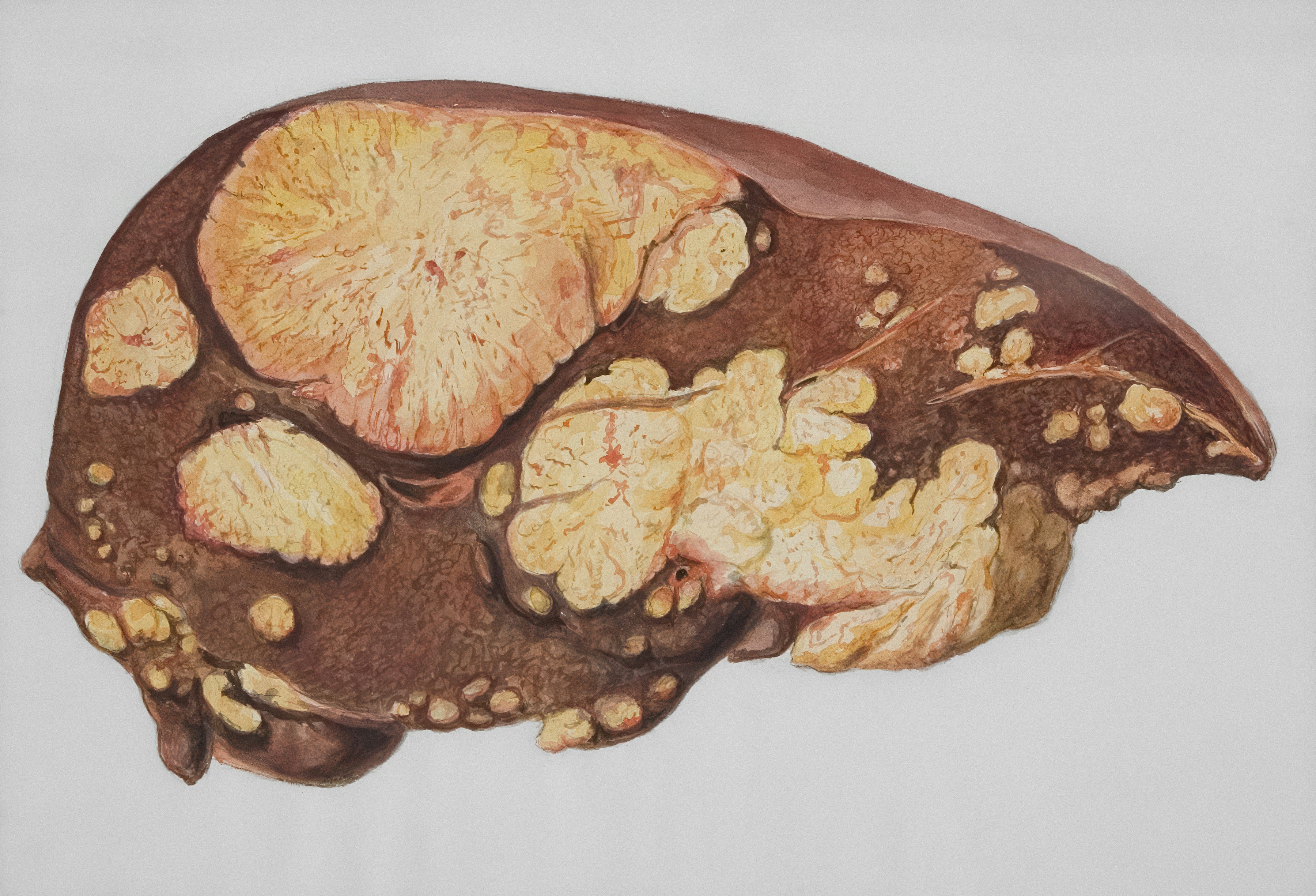 Predicción conforme de riesgo de NAFLD usando Gradient Boosting
