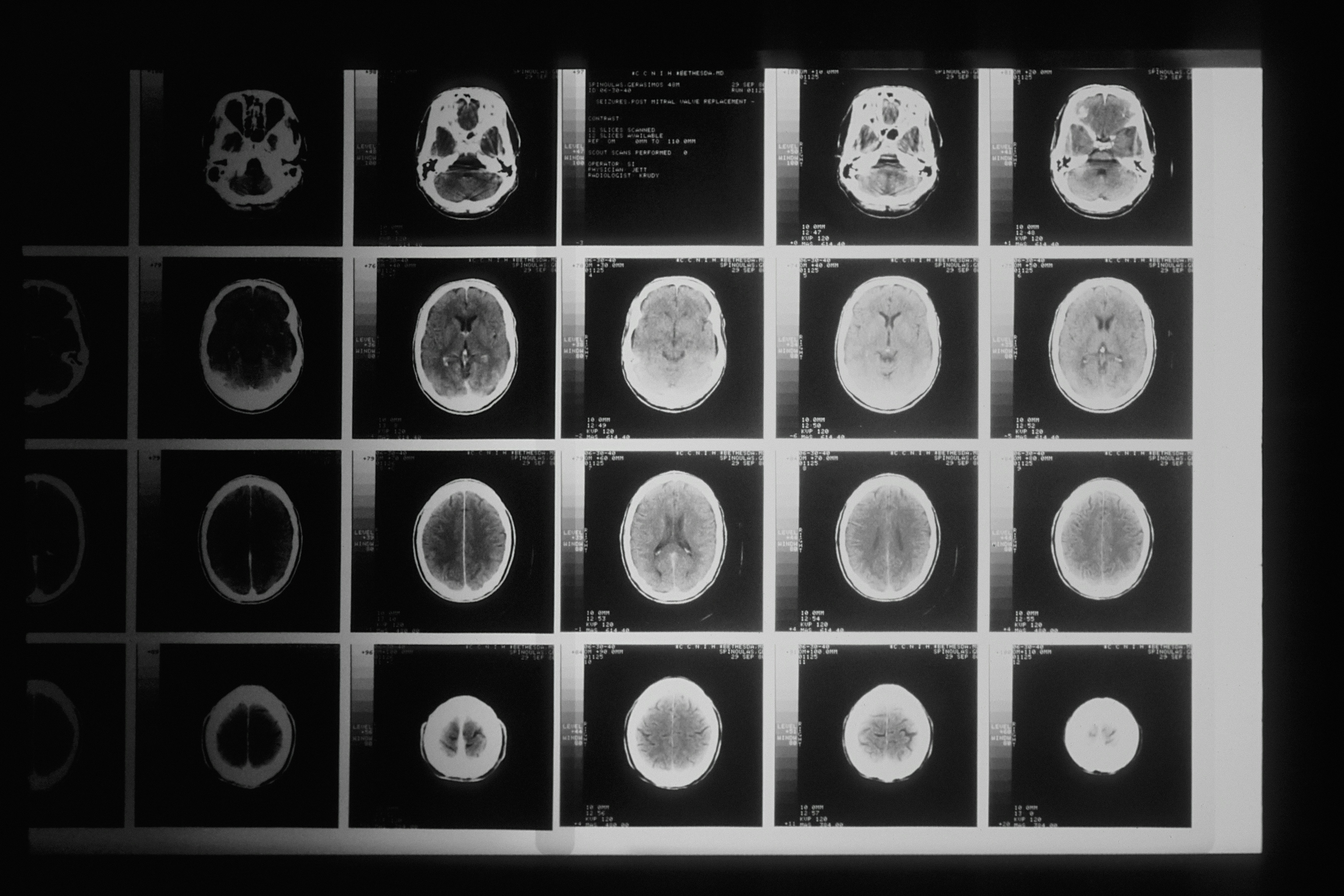 Privacidad Diferencial Adaptativa para la Segmentación Federada de Imágenes Médicas a Través de Diversas Modalidades
