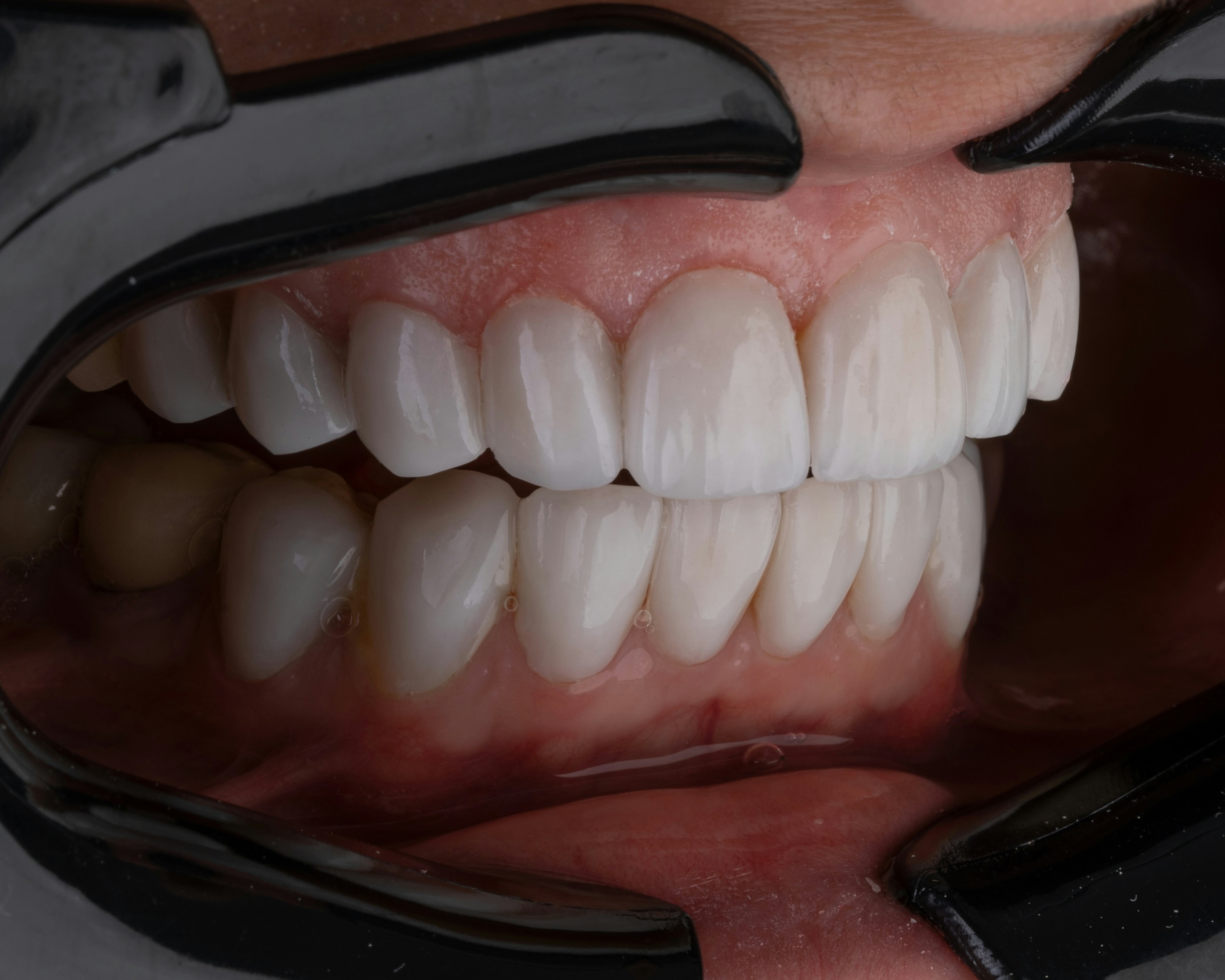 Reconstrucción 3D de cavidad oral con deep learning e imágenes intraorales 2D